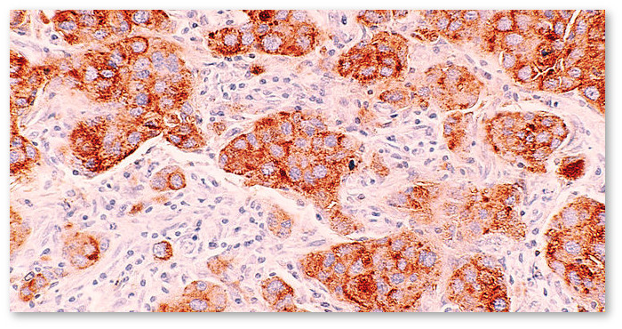 breast-cancer-marijuana-06-10-720x340