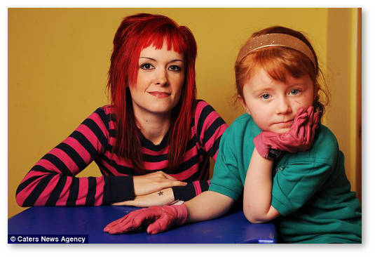 konoplya-i-bulleznyj-epidermoliz