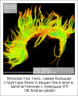 Мозолистое тело, самая большая структура белого вещества в мозге, запечатленная с помощью DTI (© Andras Jakab)