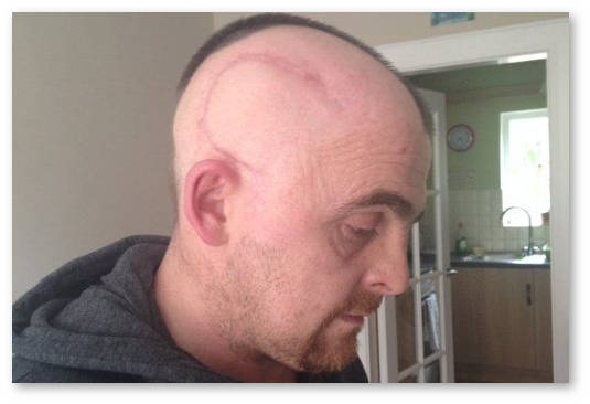 maslo kannabisa ostanovilo rost opuholi mozga