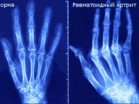 Медицинская марихуана против ревматоидного артрита?