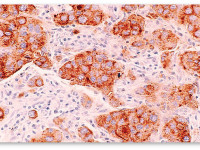 Исследование: Марихуана поможет бороться с раком груди