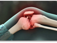 Синтетические аналоги марихуаны снимают боль при остеоартрите