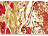 Исследование: Потенциал марихуаны в предотвращении болезней сердца